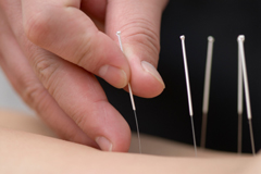 Treatment by acupuncture. The doctor uses needles for treatment of the patient.