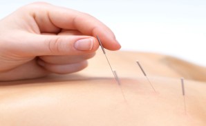 Acupuncture photo