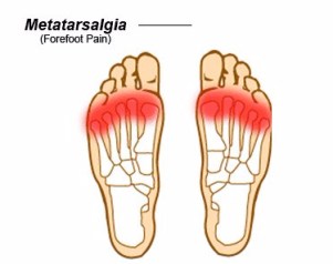 metatarsalgia