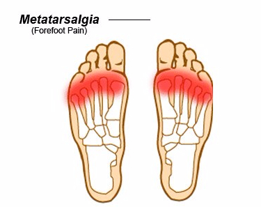 metatarsalgia