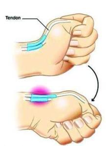 radial styloid tenosynovitis