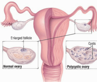 PCOS