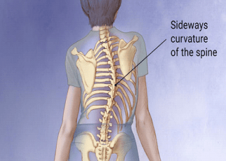 scoliosis