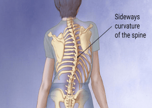 scoliosis