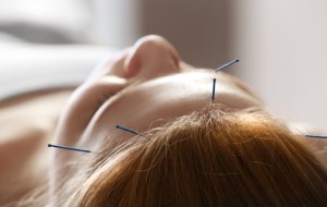 acupuncture-forehead