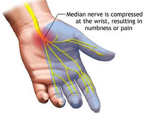carpal-tunnel-syndrome-nerve-diagram.jpg